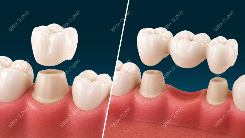 Difference Between a Crown and a Bridge